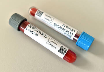 Coronavirus Covid 19 infiziert mit positivem Ergebnis Bluttestprobe - CAVF90145