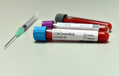Coronavirus Covid 19 infiziert mit positivem Ergebnis Bluttestprobe - CAVF90149