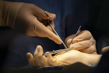 A surgeon operates a hand - CAVF92804