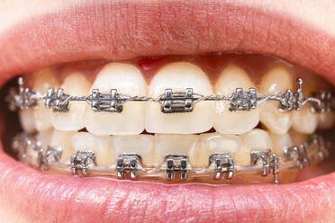 Vordere Zähne mit Zahnspange und Speisespuren. Zahnpflege Foto. Lächelnde Frau mit kieferorthopädischem Zubehör. Kieferorthopädische Behandlung - CAVF93776