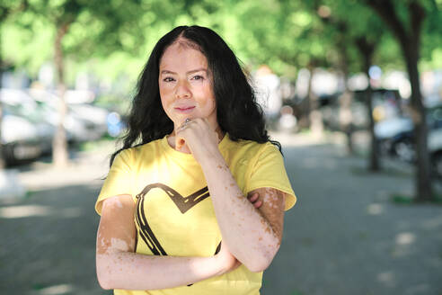 Young woman with vitiligo standing outdoors - AGOF00111