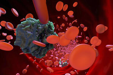 Mutated leukaemia cells in blood stream - SPCF01421