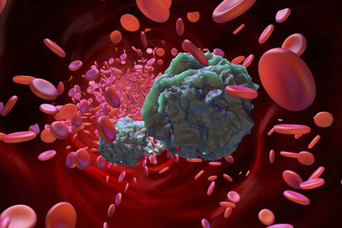 Dreidimensionale Darstellung von Leukämiezellen im Blutstrom - SPCF01548