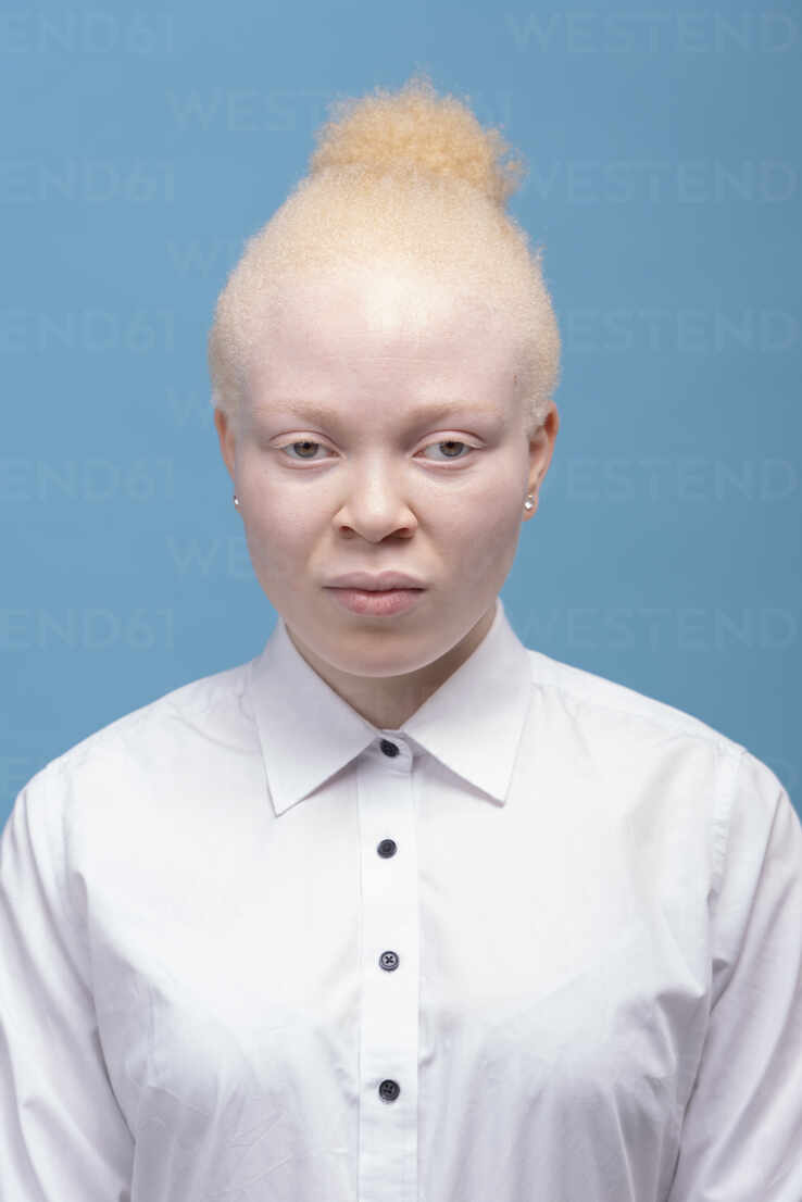 Albino frau