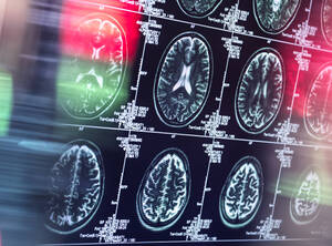 Scan des menschlichen Gehirns in einer neurologischen Klinik - ABRF00929