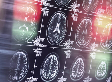 MRI scan of brain in clinic - ABRF00930