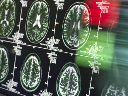 Medizinische MRT-Untersuchung in einer neurologischen Klinik - ABRF00931