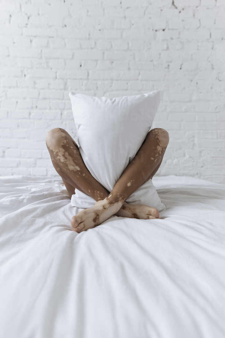 https://us.images.westend61.de/0001650480pw/woman-with-vitiligo-holding-pillow-between-legs-on-bed-in-front-of-white-wall-at-home-SIF00011.jpg