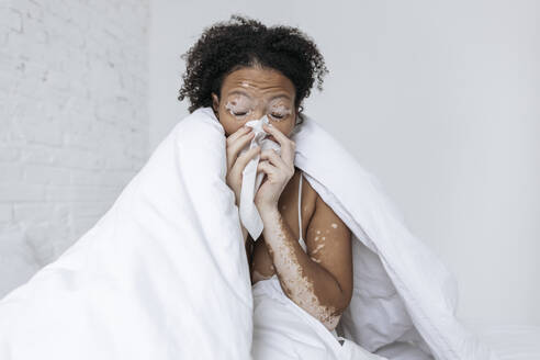 Kranke Frau mit Vitiligo schnäuzt sich zu Hause die Nase mit Seidenpapier - SIF00025