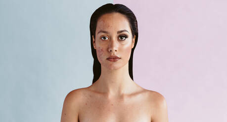 Porträt einer Frau mit Akne auf der einen Gesichtshälfte und klarer Haut mit Make-up auf der anderen Hälfte, kontrastierendes Gesicht vor und nach dem Make-up einer Frau mit Akneproblem. - JLPSF06196