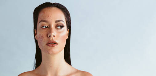 Frau mit Akne-Entzündung im Gesicht mit partiellem Make-up. Frau verwendet Make-up, um Akne-Problem zu decken. - JLPSF06197