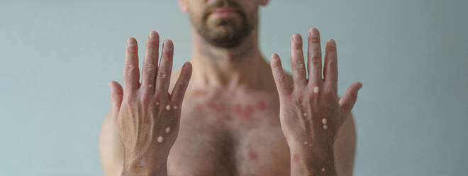 A male hands affected by blistering rash because of monkeypox or other viral infection on white background - HPIF04311