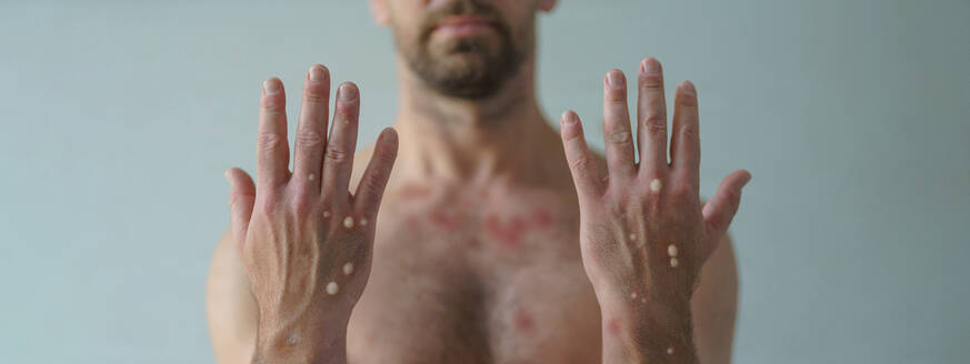 Eine männliche Hand mit blasenbildendem Ausschlag aufgrund von Affenpocken oder einer anderen Virusinfektion auf weißem Hintergrund - HPIF04311