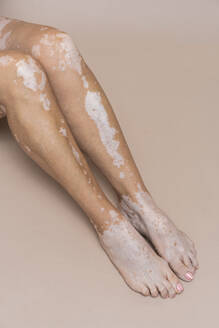 Beine einer Frau mit Vitiligo vor rosa Hintergrund - AAZF00773