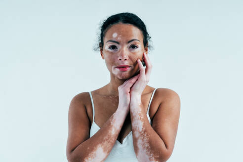 Beautiful woman with vitiligo skin posing in studio. Concept about body positivity and self acceptance - DMDF06798