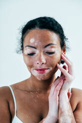 Beautiful woman with vitiligo skin posing in studio. Concept about body positivity and self acceptance - DMDF06803