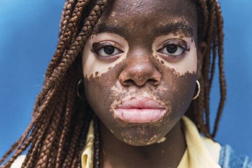 Young woman with depigmentation on face against blue background - PNAF06042