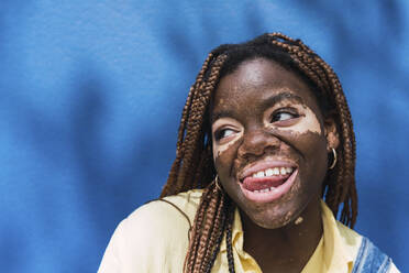 Young man with vitiligo having a cup of coffee in a cafeteria