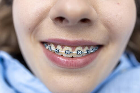 Detailansicht der Mundspange Lächeln einer jungen Frau mit blauem Hemd. - ADSF49223