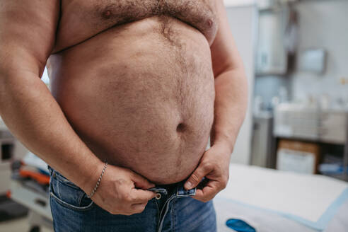 Nahaufnahme des Bauches eines übergewichtigen Patienten. Hoher Taillenumfang eines fettleibigen Mannes. Konzept der Gesundheitsrisiken von Übergewicht und Adipositas. - HPIF31460