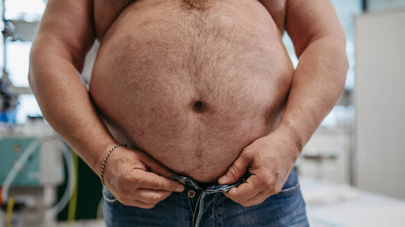 Nahaufnahme des Bauches eines übergewichtigen Patienten. Hoher Taillenumfang eines fettleibigen Mannes. Konzept der Gesundheitsrisiken von Übergewicht und Adipositas. - HPIF31461