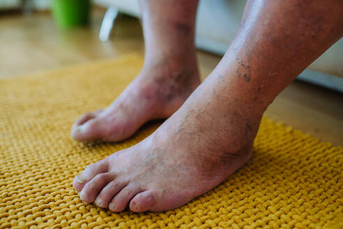 Eine Nahaufnahme der Füße eines Mannes mit diabetischen Fußkomplikationen, die seine nicht heilenden Geschwüre, Hautverfärbungen und Zehendeformitäten zeigen. - HPIF32973
