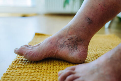 Eine Nahaufnahme der Füße eines Mannes mit diabetischen Fußkomplikationen, die seine nicht heilenden Geschwüre, Hautverfärbungen und Zehendeformitäten zeigen. - HPIF32974